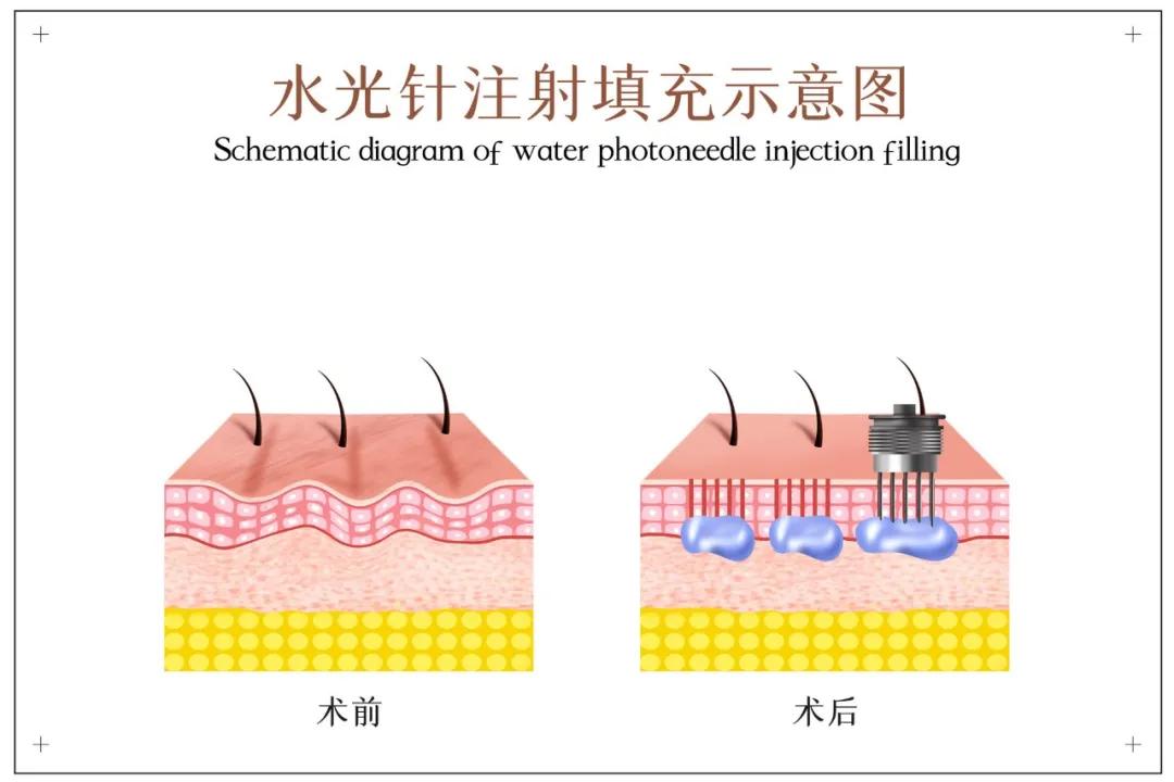 医生科普光子水光针,水光针专业知识分享