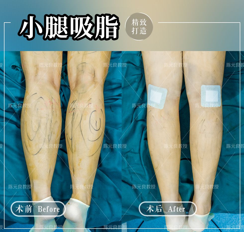 大小腿吸脂半个月小腿一碰就痛,小腿吸脂可以瘦几厘米