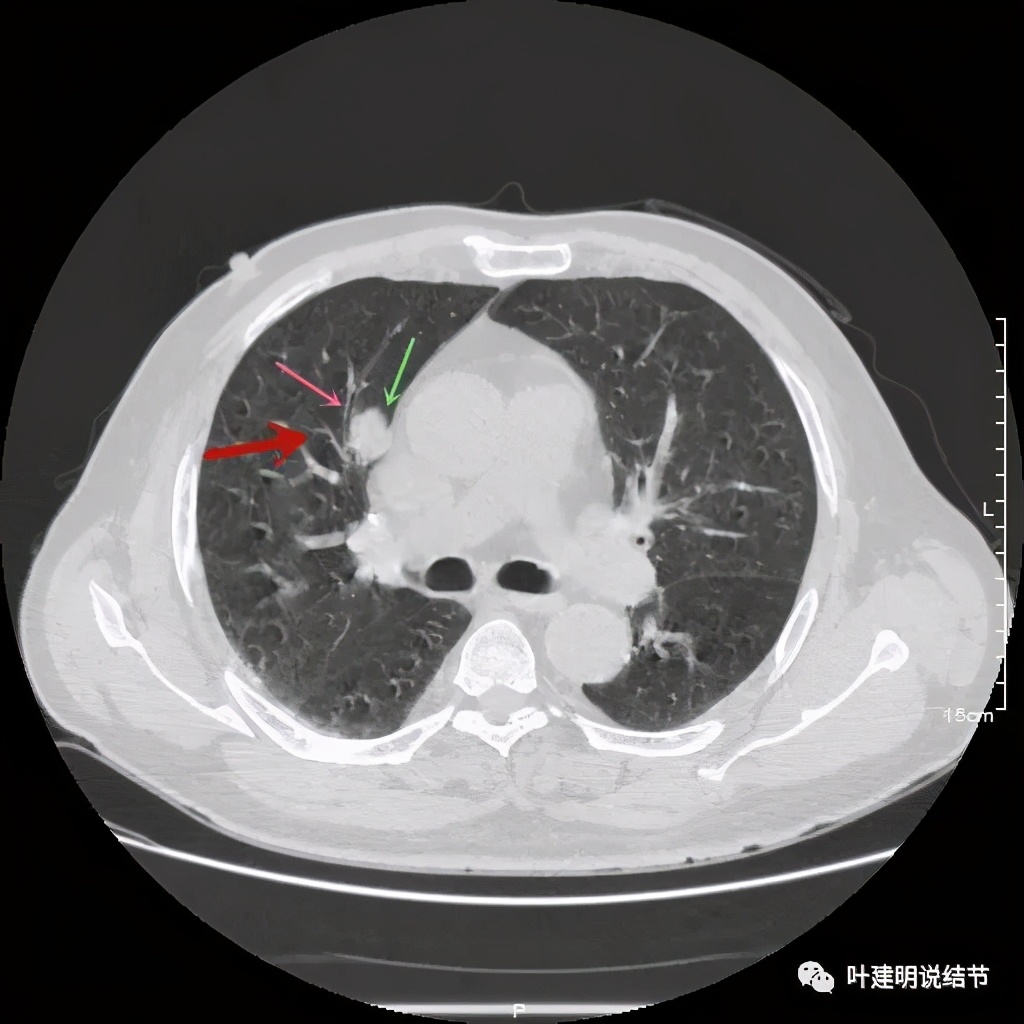 误诊报告图片,误诊案例及案例分析
