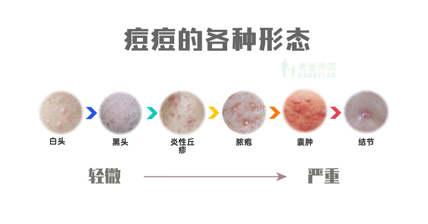 怎样才是消灭痘痘的正确打开方式,痘痘到底要怎么才能消除