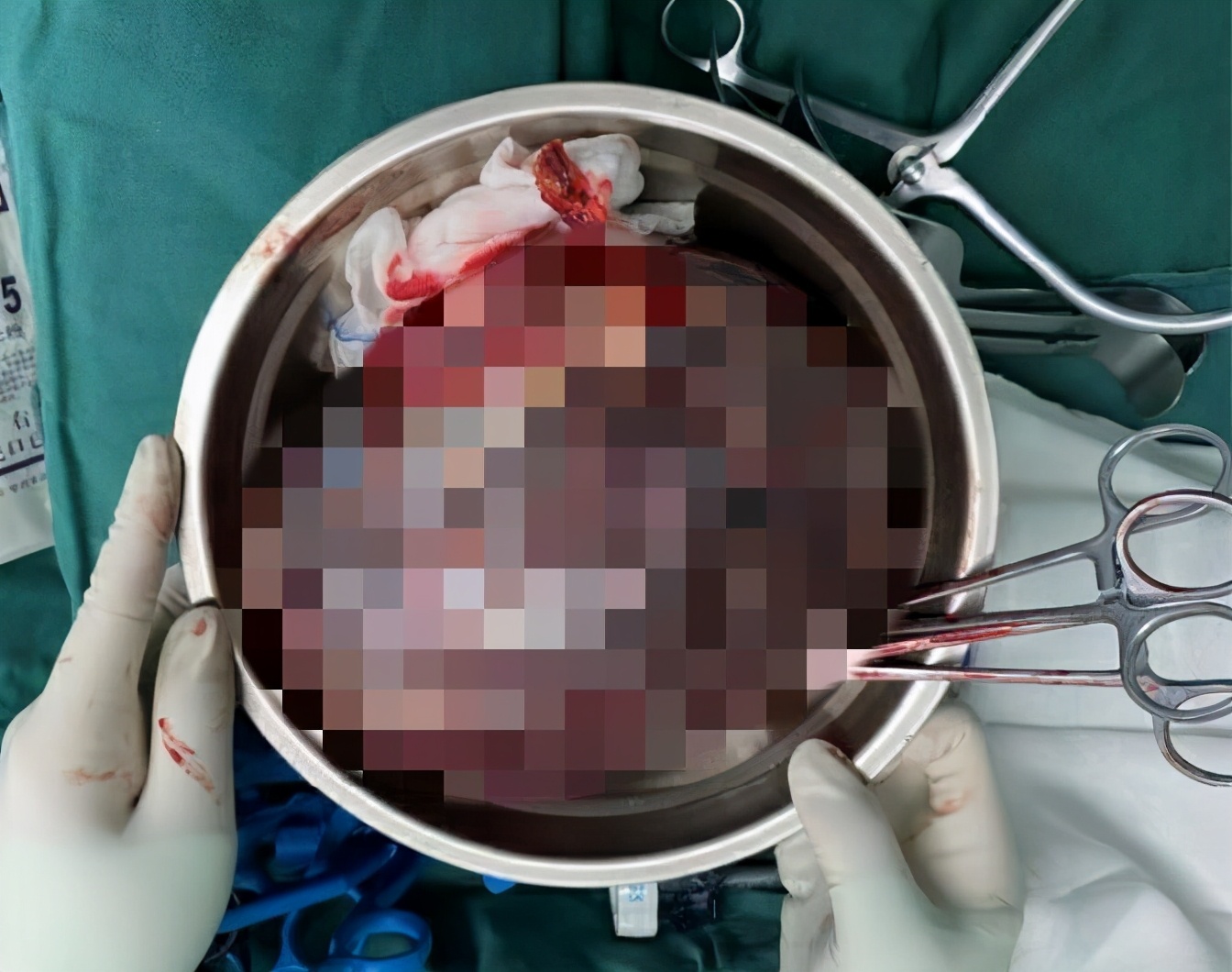 排球那么大的肿块！75岁阿婆腹部越长越大的原因找到了