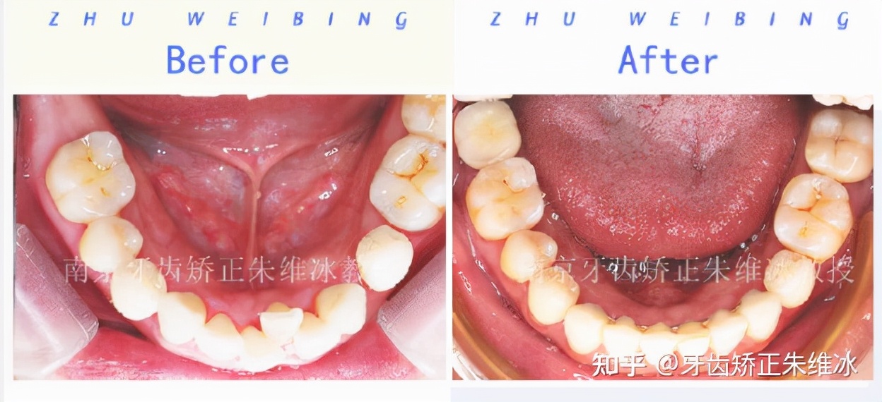 南京牙齿矫正龅牙前突要多少钱,36岁牙周不好龅牙能整吗