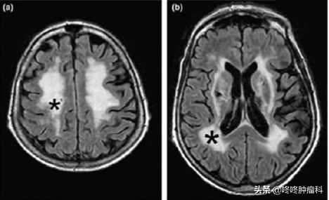 服用靶向药会不会刺激肿瘤生长,服用靶向药还会复发吗