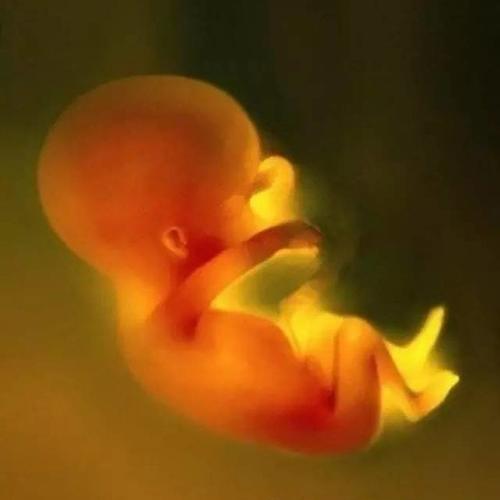 胎儿肾积水要怎么处理,肾积水剖腹产有危险吗