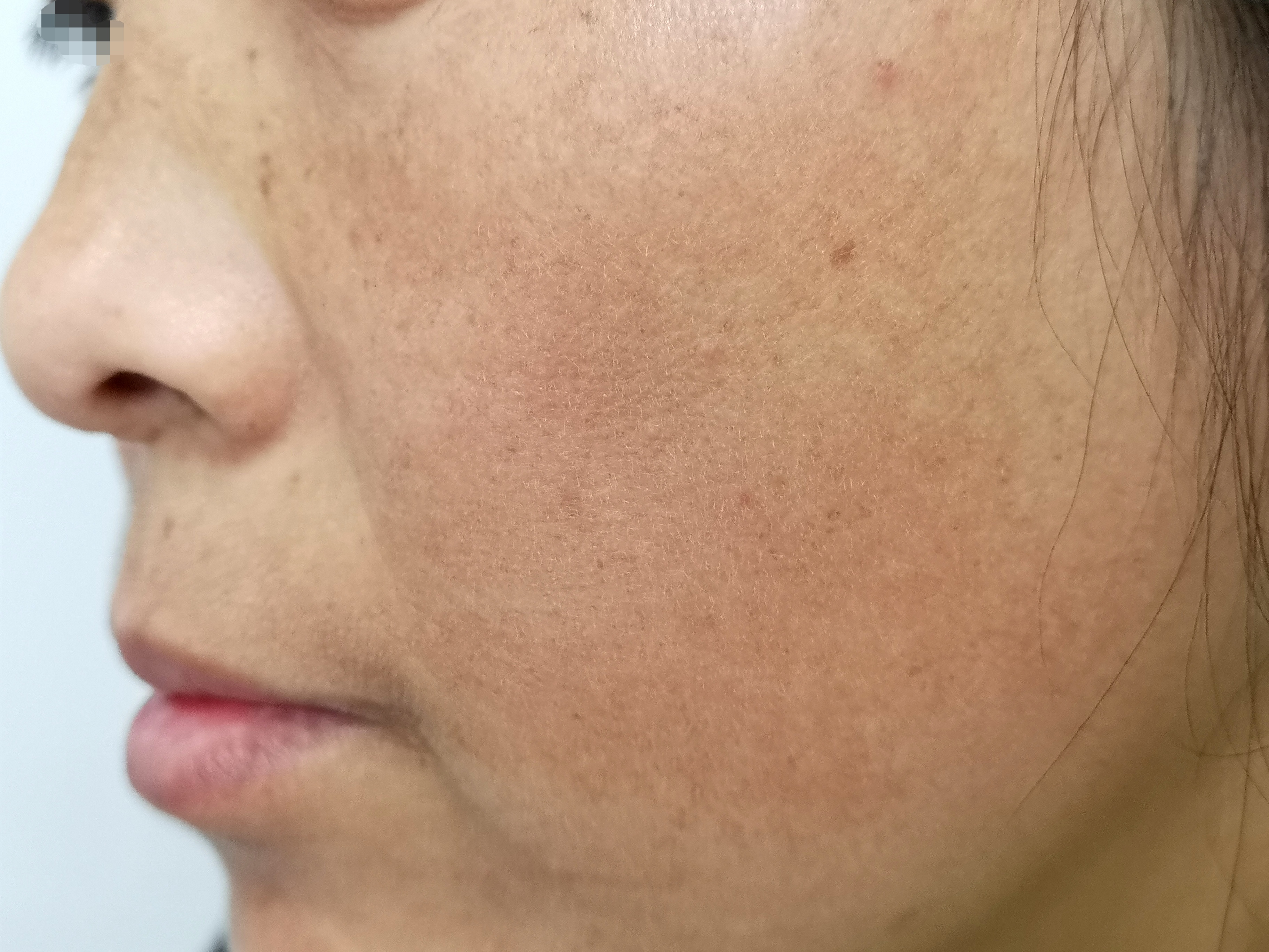 斑治疗越早效果越好,斑有没有办法治