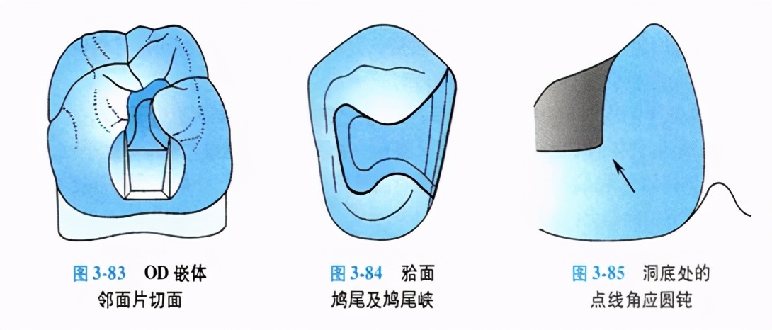 牙科嵌体的处理,牙科医生讲义