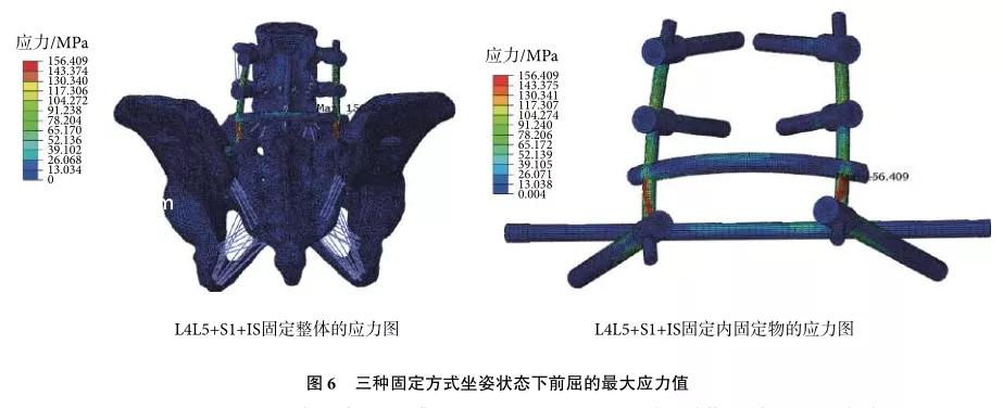 骶骨骨折没内固定能评几级,u型钉67公分单价