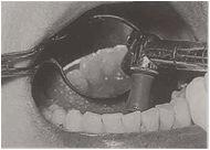 多图直击！牙医如何用抛光把孩子的牙洗干净？#葉子口腔科普#