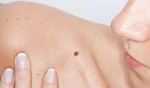激光点痣不小心照了紫灯怎么办,切除黑色素痣可能癌变吗