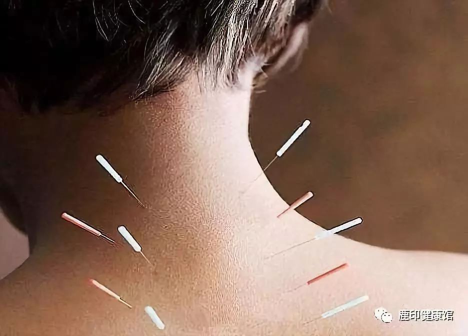 30岁颈椎增生,58岁体检发现颈椎增生怎样治疗