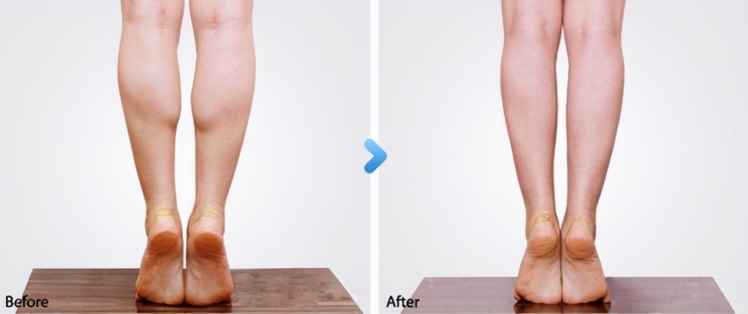 小腿太瘦很难看怎么锻炼,小腿太粗了怎么都瘦不下来