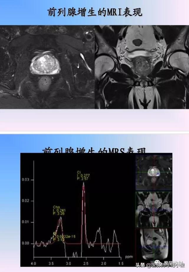 前列腺磁共振影像解剖,前列腺mri正常诊断报告模板