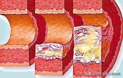 高血压危象的护理应急预案,患者发生高血压危象的应急流程