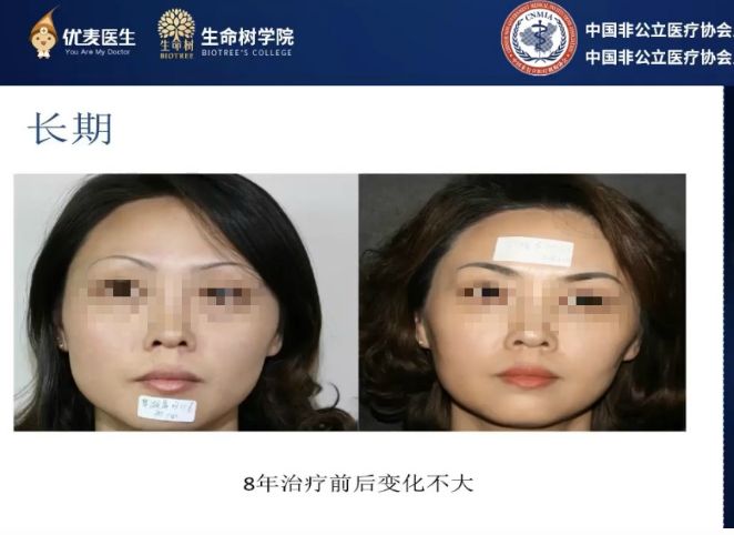 哪种医美项目祛痘印最有效,最有效的医美抗衰项目