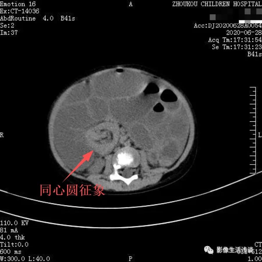 小朋友腹痛呕吐无其他症状,孩子有腹痛呕吐症状家长切莫大意