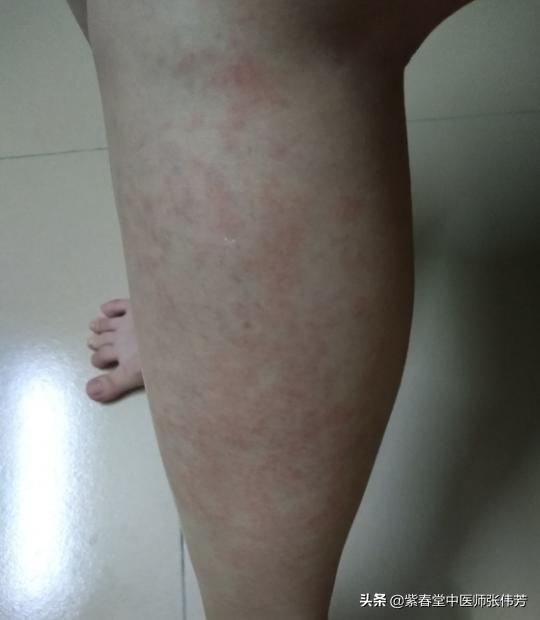 过敏性紫癜红点多长时间可以消退,过敏性紫癜红点消退后还需要忌口