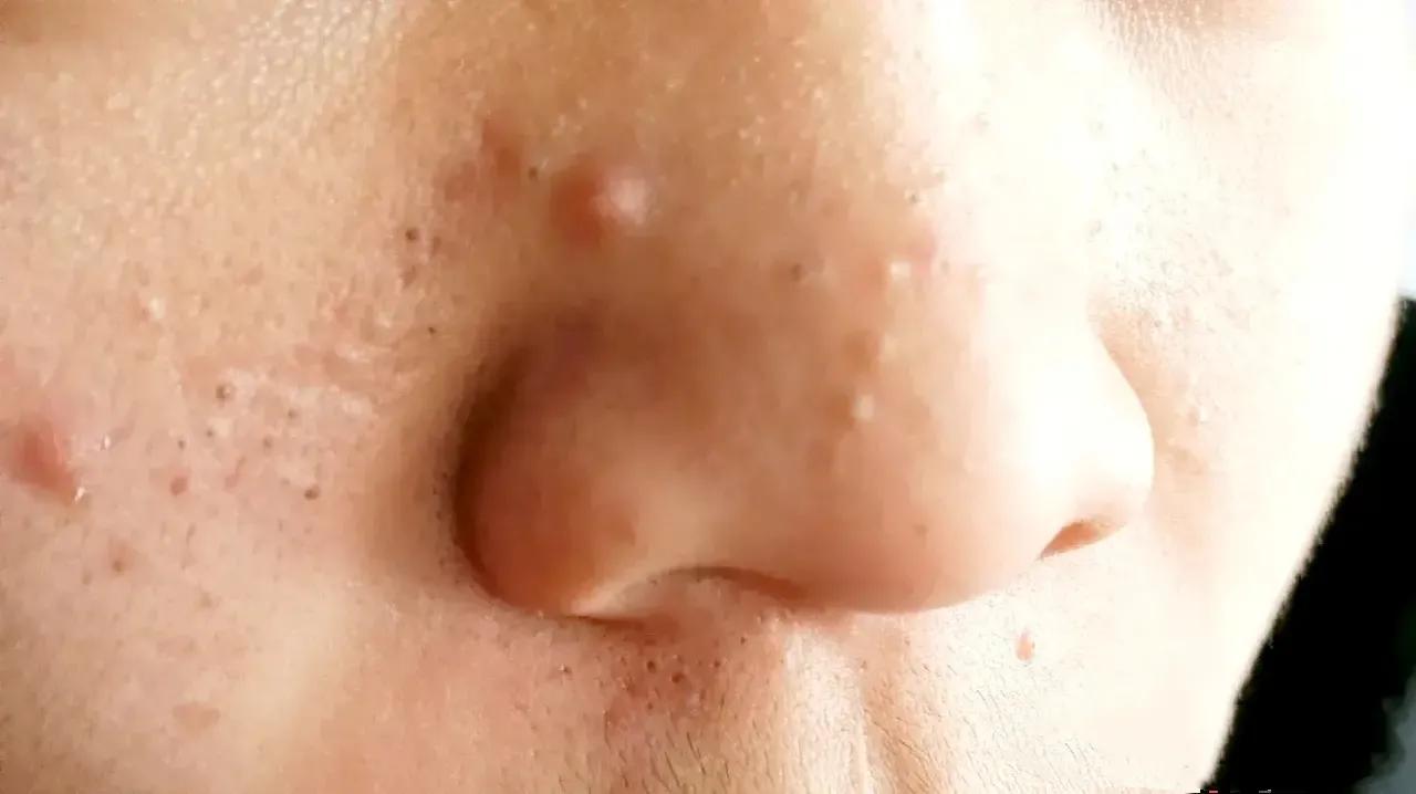 去黑头和白头的最好方法,对付黑头最佳方法不伤皮肤