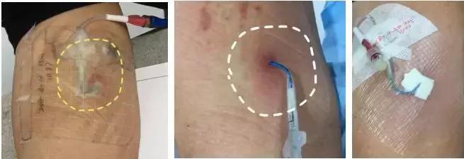 水泡破了如何处理,手掌水泡破了怎么处理