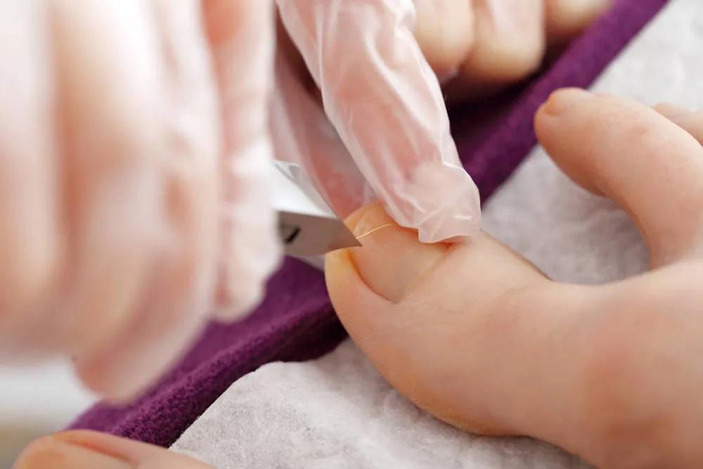 甲沟炎只是撞到墙上痛严重吗,甲沟炎但是不疼有必要弄吗