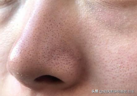 去黑头的方法快速有效,去除黑头以后皮肤该如何护理