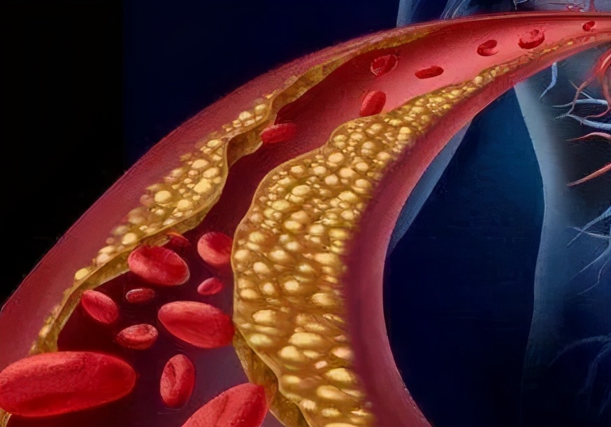 一级预防隔一天吃一次阿司匹林,哪类人群需要吃阿司匹林