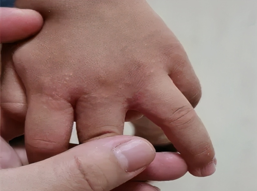 手上长一片小疙瘩还痒是怎么回事,天一热手上就起一层小疙瘩还很痒