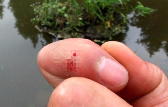 钓鱼时被刺到,为什么每次钓鱼都会被鱼钩伤到