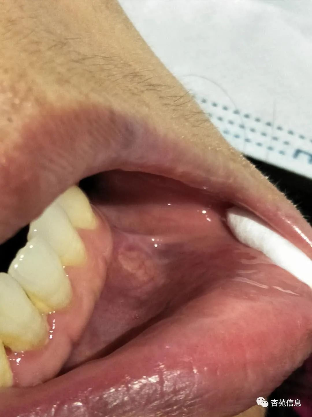 中医院介入三氧疗法,慢性疼痛介入治疗方法