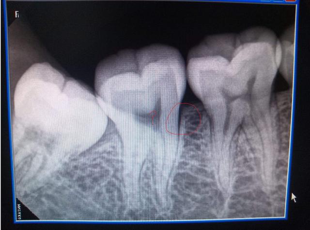 智齿冠周炎治疗方法的全过程,智齿不能萌出导致牙龈肿痛怎么办