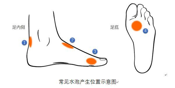 运动起水泡怎么处理好得快,收藏运动