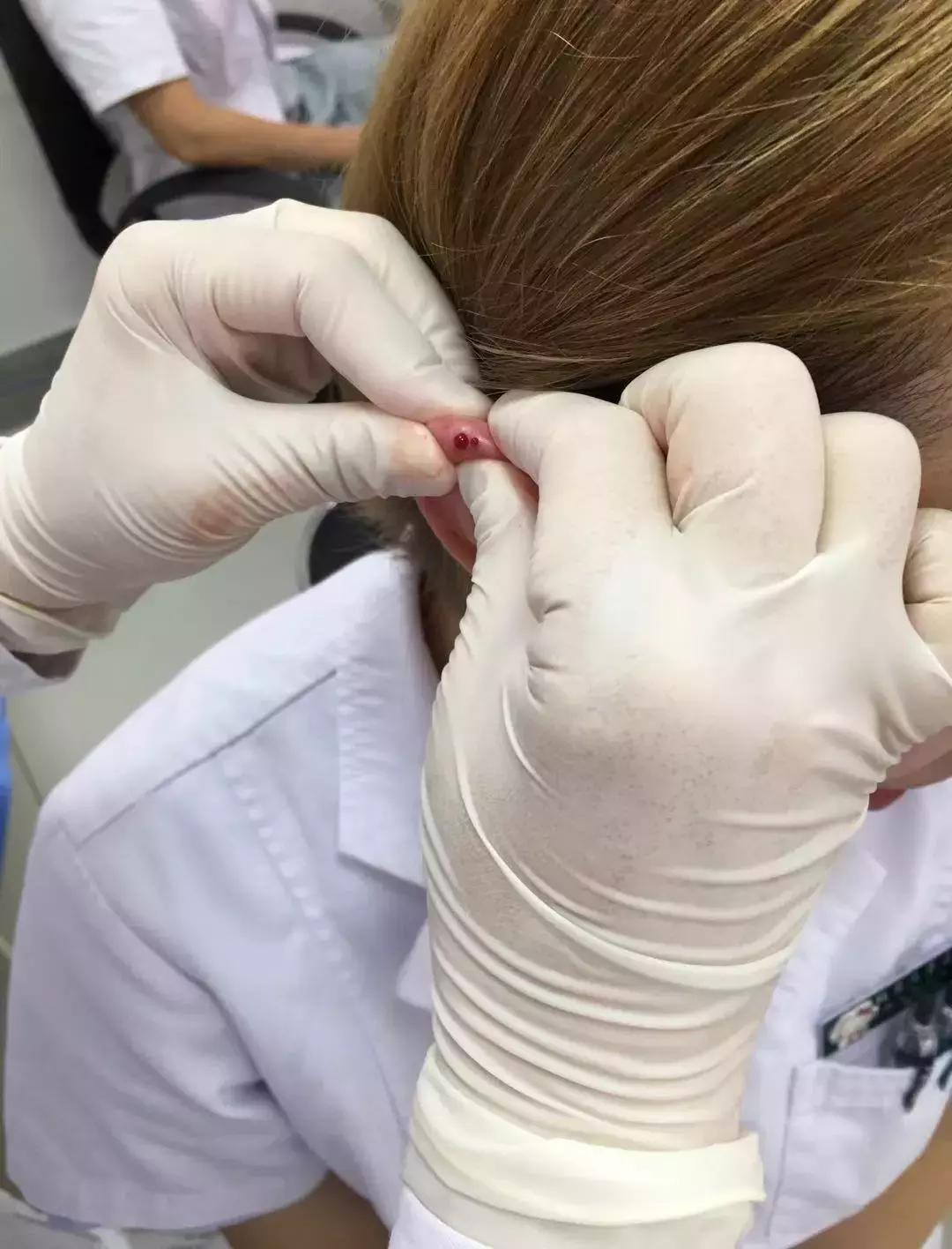 疏通经络穴位放血疗法好吗,专家建议按摩穴位