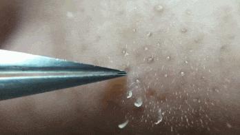 根治黑头的最佳方法,怎么才能彻底治好黑头