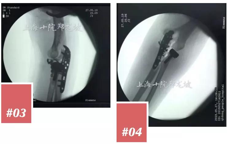 肘关节恐怖三联征康复训练图,肘关节恐怖三联征能彻底治愈吗