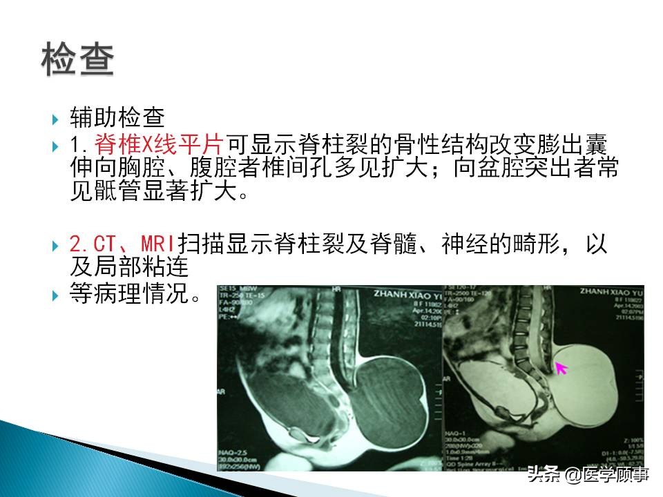 先天性脊柱裂是怎么来的,先天性脊柱裂的孕妇