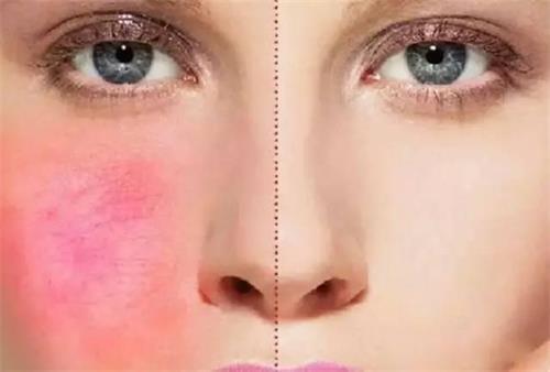 混油敏感肌最佳护肤方法,改善红血丝敏感肌的护肤产品