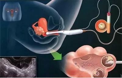 试管取完卵不麻醉过程疼吗,北医三院试管采卵需要麻醉吗