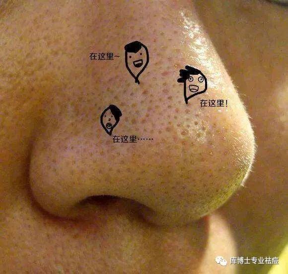 鼻翼毛孔粗大怎么上粉底,鼻翼两侧毛孔粗大卡粉怎么解决