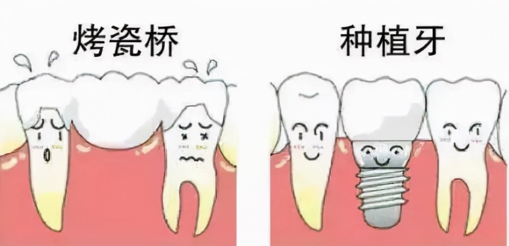 烤瓷牙牙齿缺失又不想种牙怎么办,有没有什么牙齿是不能做种植牙的