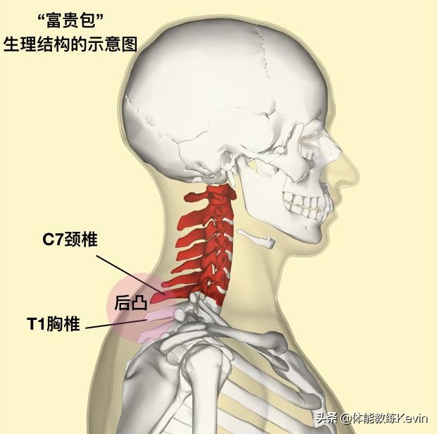 颈椎富贵包的危害有哪些,富贵包的危害及锻炼方法