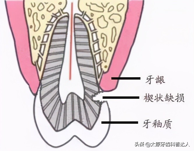牙颈部楔状缺损牙疼吃什么药,牙颈部龋坏和楔状缺损的差别