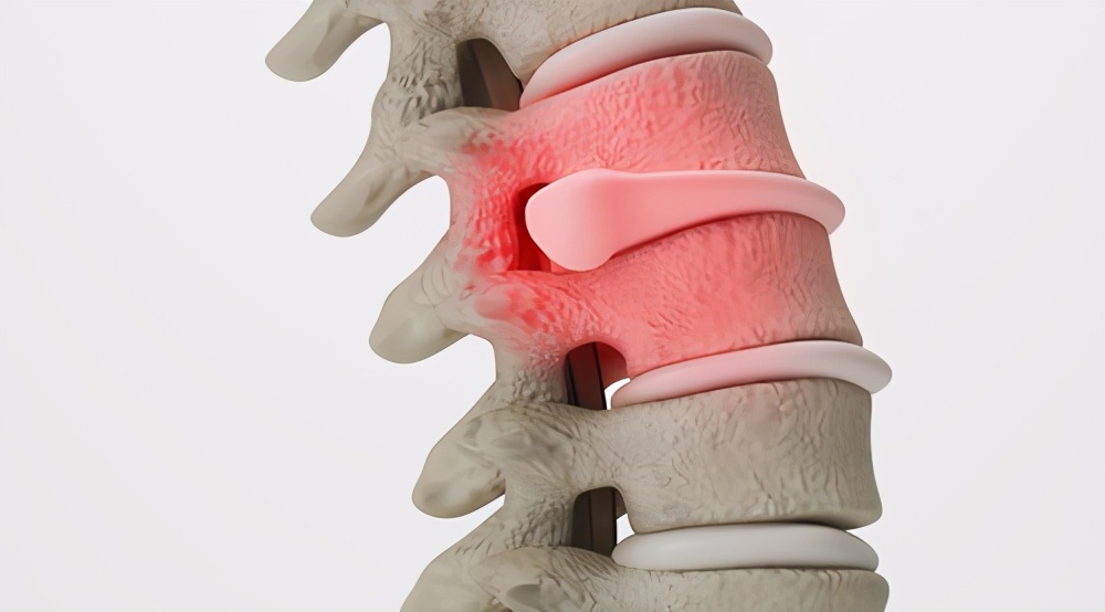 腰椎间盘突出医生建议微创手术,请问医生腰椎间盘突出用什么药