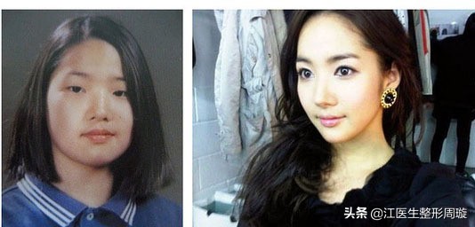 瘦脸针不要随便打,瘦脸针连续打几年真实感受