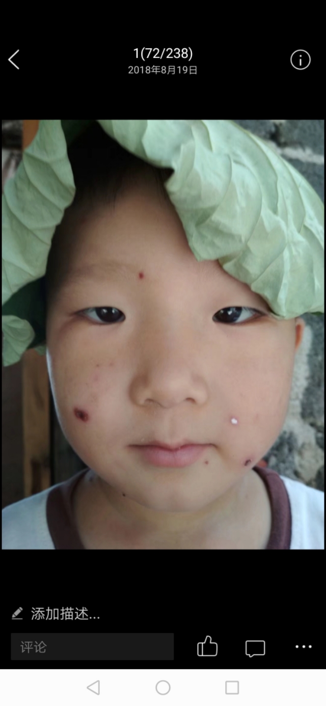 儿童水痘的真实故事,四岁的水痘