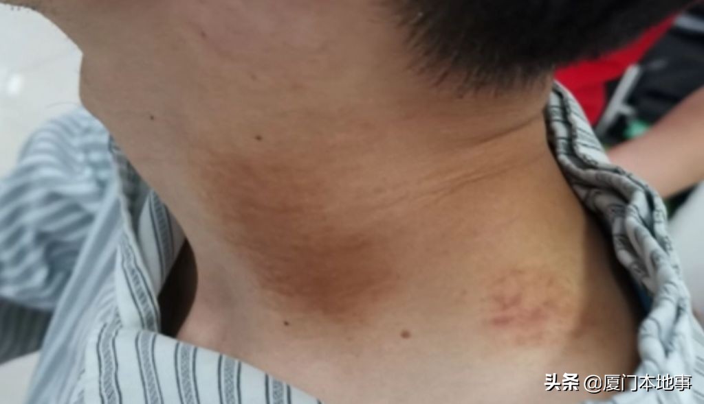 家门口按摩刮痧后,36岁男子脑梗!这个部位真的不能随便按