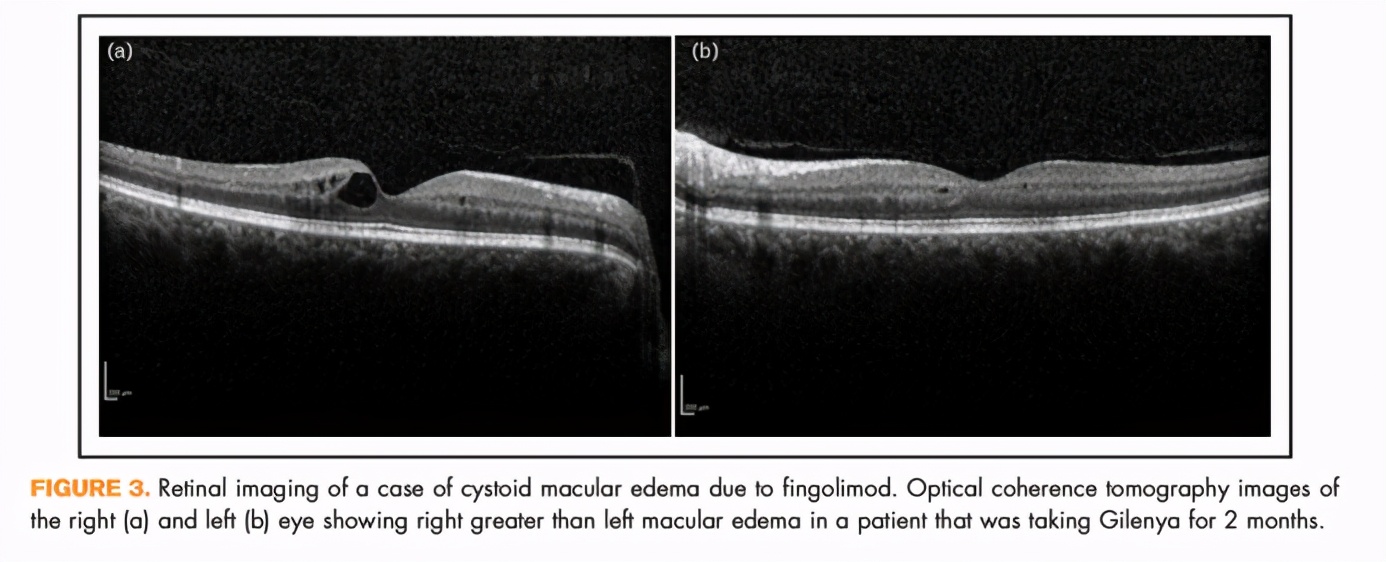 黄斑病变特效药配方,治疗黄斑病变最好的偏方