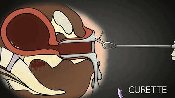 25岁女子做无痛人流,未婚女孩六年做了17次人流