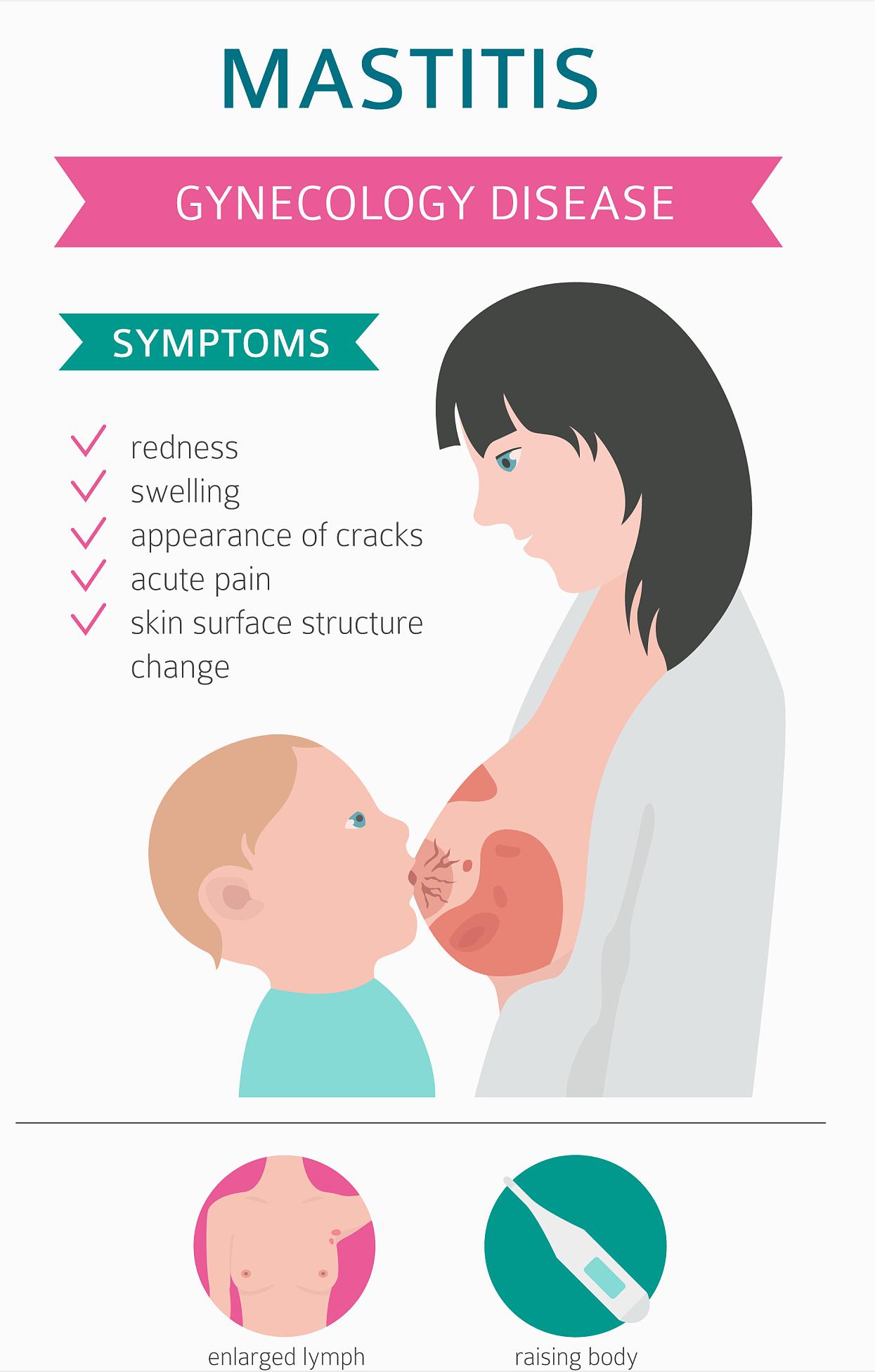 产后哺乳期乳腺炎怎么治疗,奶水淤积引发乳腺炎怎么办