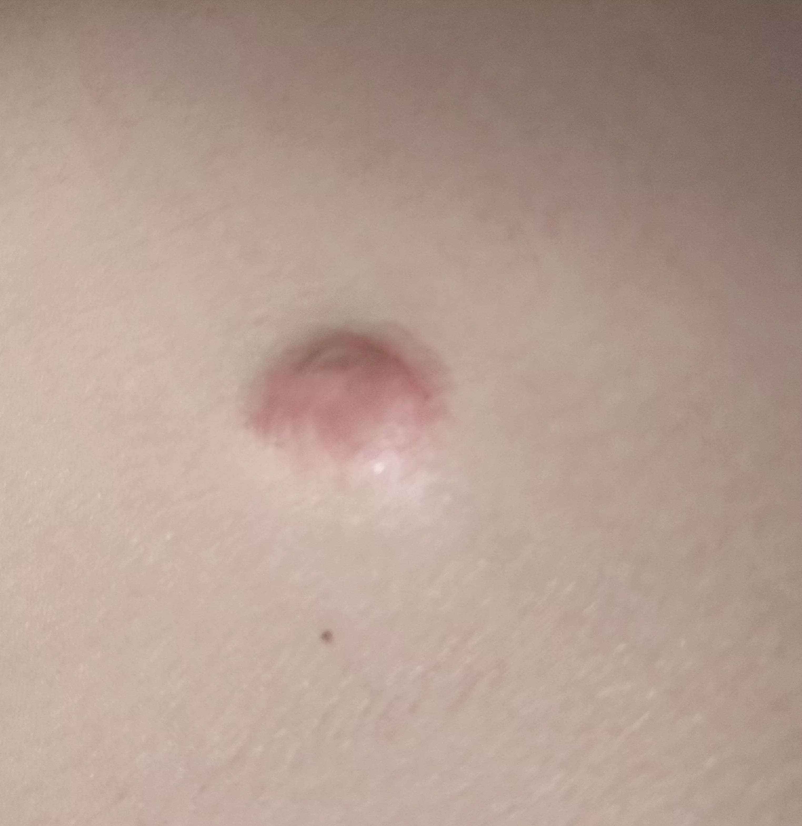 小孩身上有小黑点怎么回事,小孩身上小黑点越来越多