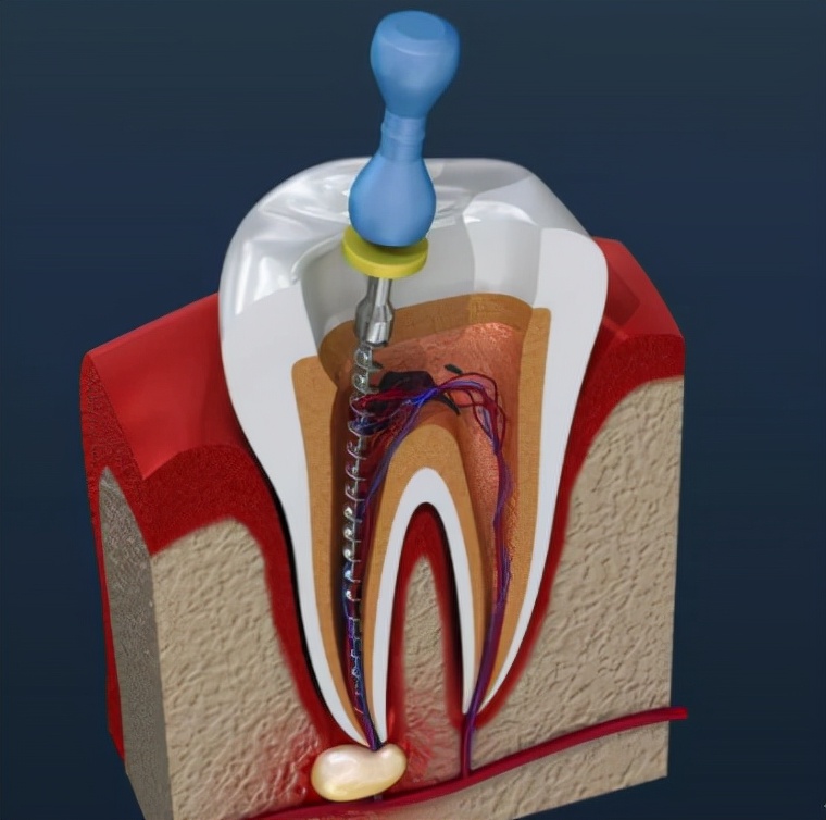 根管治疗怎样才要做,根管治疗的药不小心弄掉了