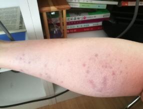 拍打膀胱有什么好处,拍打膀胱有助排尿吗